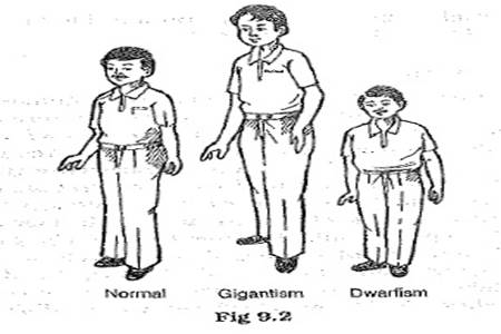Example of normal, Gigantism and dwarfism in a sketch of a man.  https://c1.staticflickr.com/7/6162/6214183450_55c5fcb35b.jpg